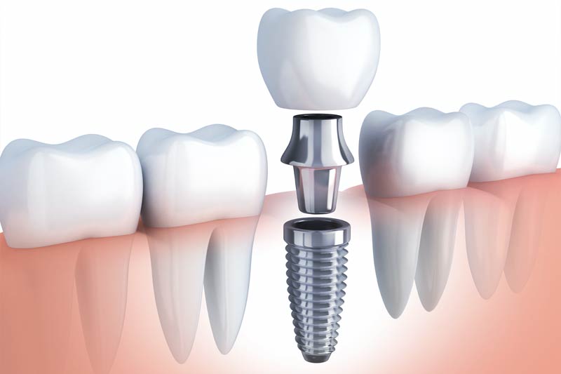 Implants Dentist in Anaheim