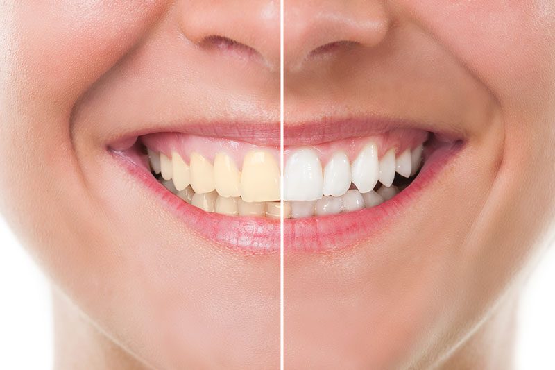 Teeth Whitening in Anaheim